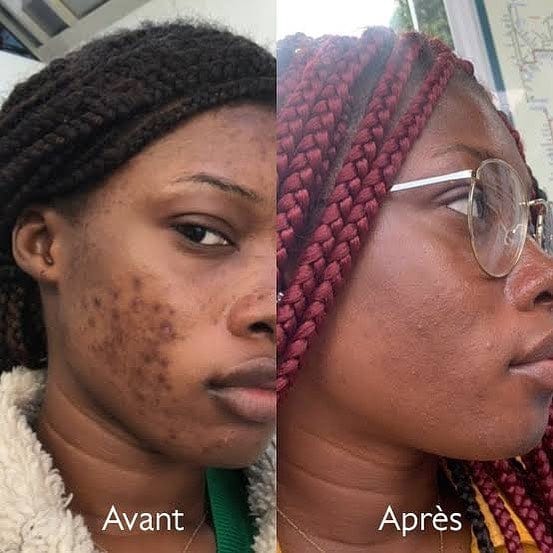 Crème au Venin d'Abeille | Répare votre peau en 72 heures!